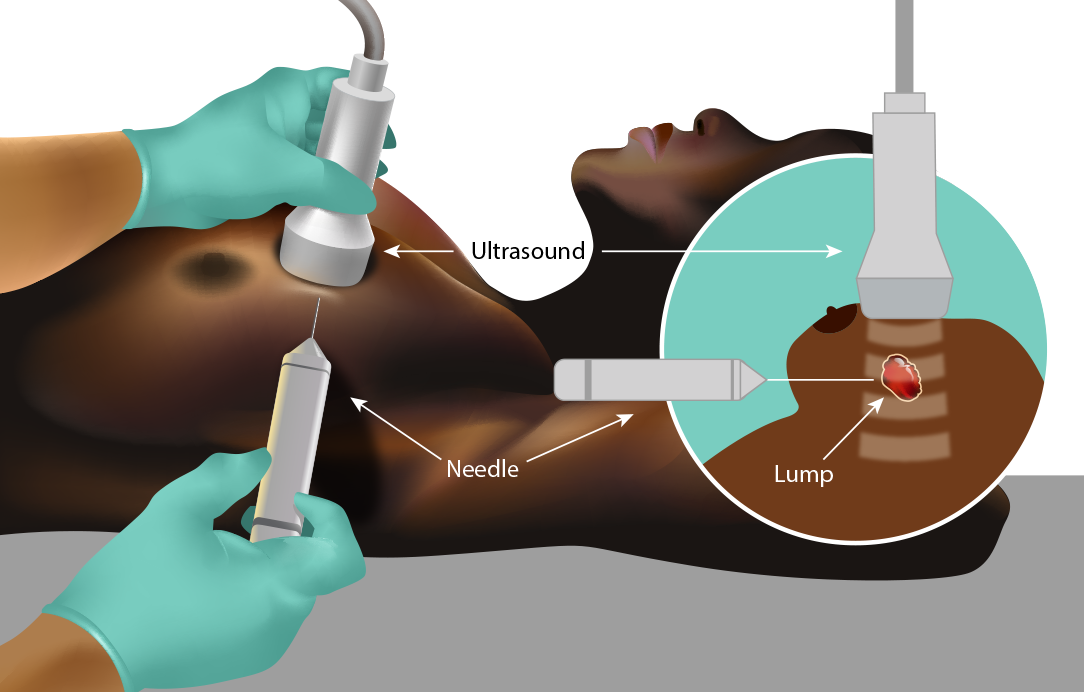 How To Prepare For An Ultrasound Guided Breast Biopsy How To Prepare For An Ultrasound Guided Breast Biopsy